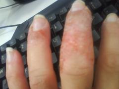 Fingers before treatment